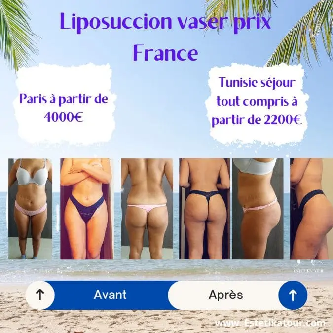 Avant et apres la chirurgie esthetique
