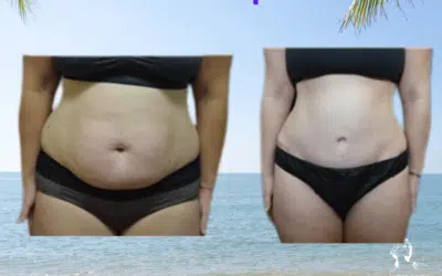 abdonimoplastie avant et apres Abdominoplastie avant et après