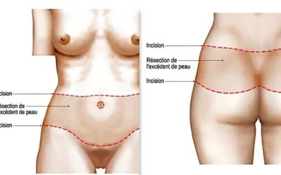 bodylift bodylift avant après