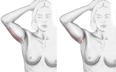 lifting des bras ou brachioplastie Lifting des bras avant apres