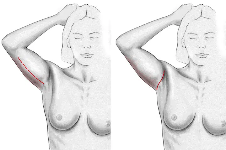Lifting des bras avant apres