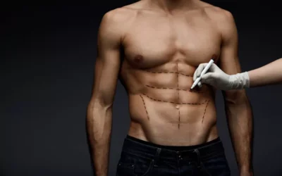 liposuccion homme avant apres Liposuccion homme avant apres