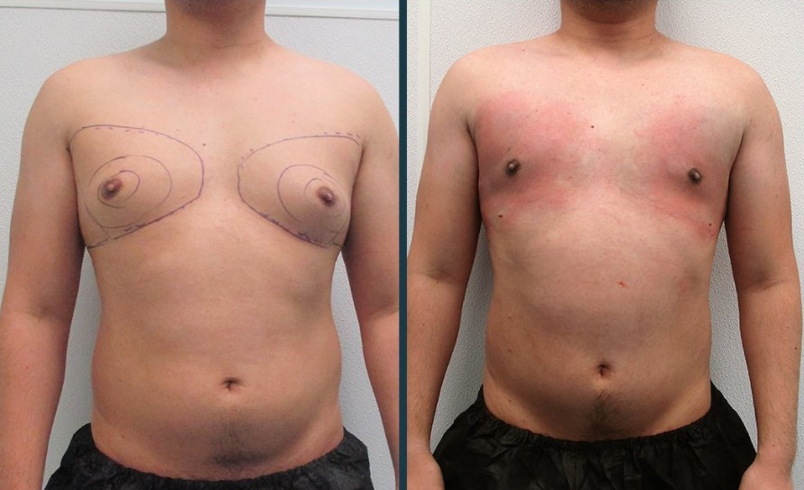 liposuccion homme avant apres