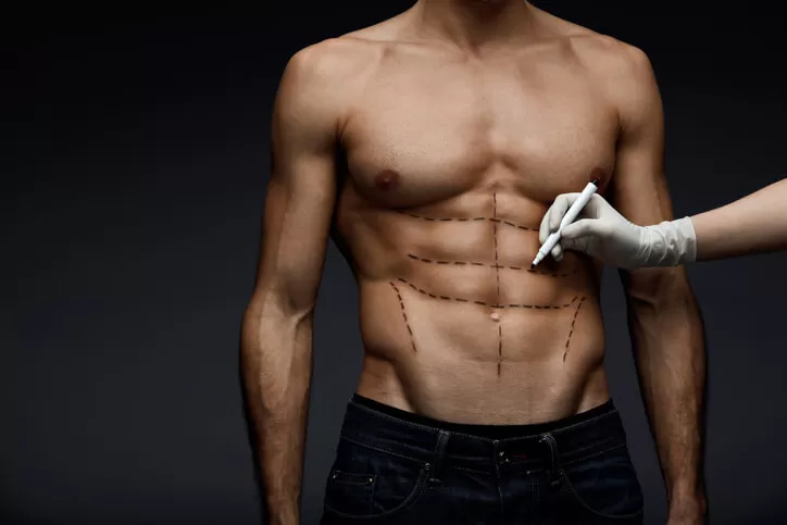 Liposuccion homme avant apres