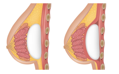 Augmentation mammaire sur le muscle avis Augmentation mammaire sur le muscle avis