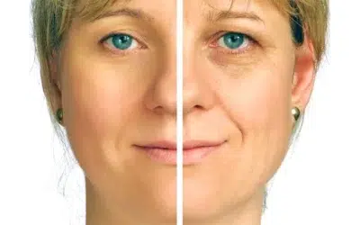 Graisse dans le visage Le lipofilling du visage Graisse dans le visage: Le lipofilling du visage