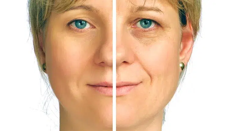 Graisse dans le visage: Le lipofilling du visage