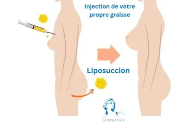 Augmentation mammaire sans implant