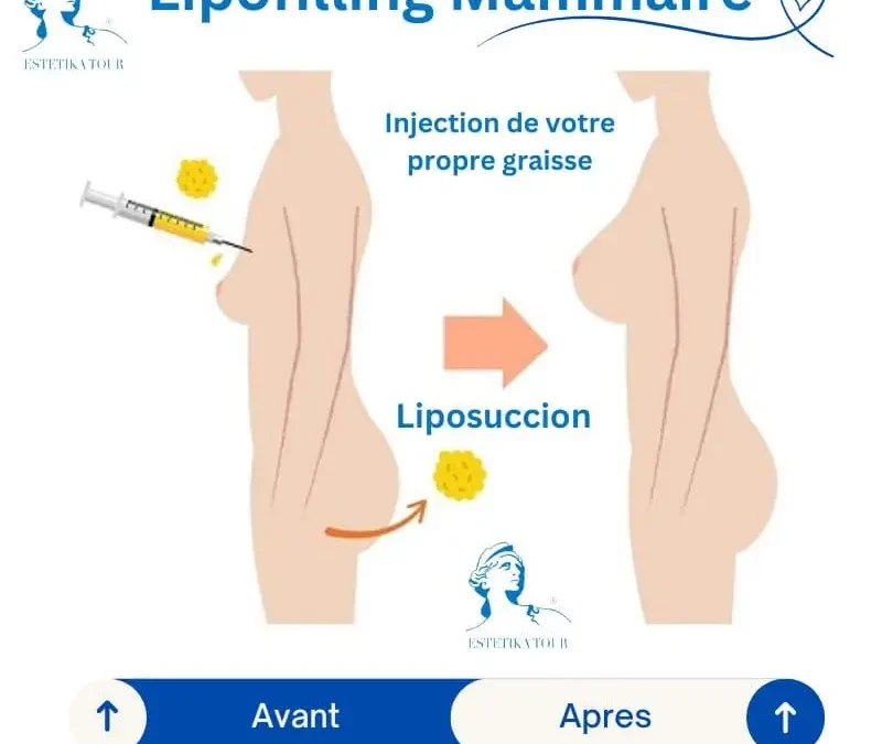 Lipofilling mammaire tunisie, Augmentation mammaire sans implant