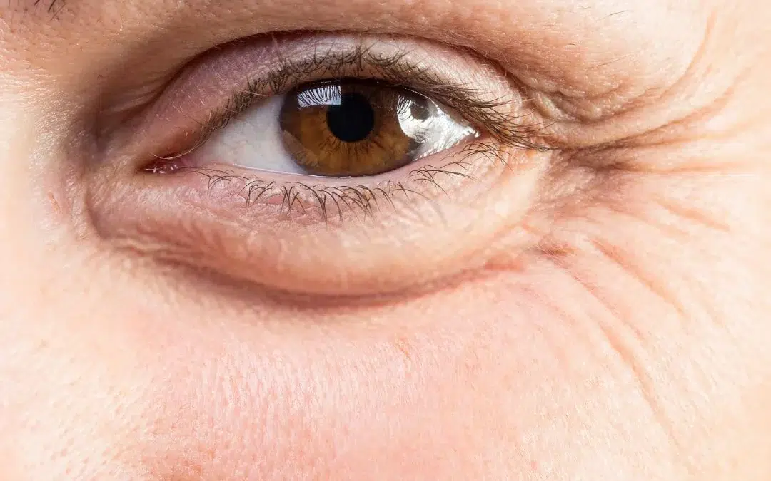 Poches sous les yeux : causes, traitements et bien-être
