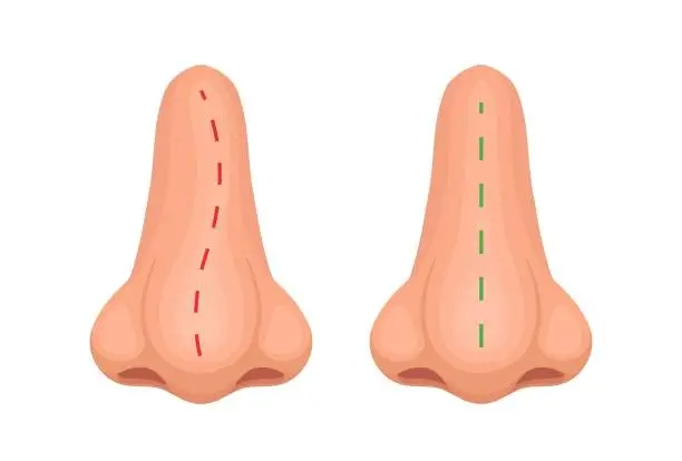 Comment se faire rembourser la chirurgie du nez ?, Deviation de la cloison nasale nez cassé