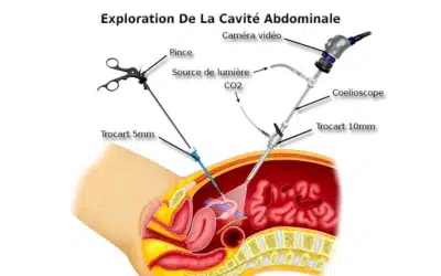 Perte de poids après cœlioscopie