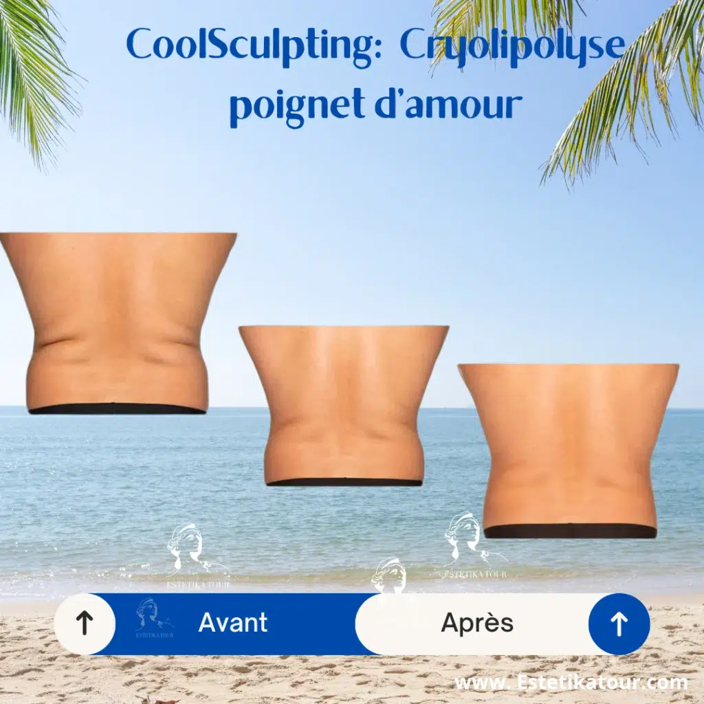 Cryolipolyse avant après coolsculpting