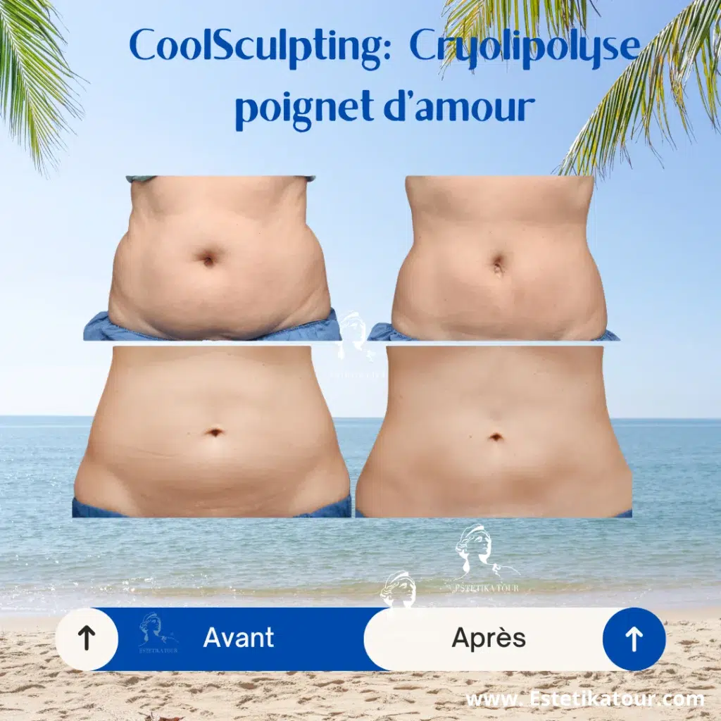 Cryolipolyse avant après coolsculpting