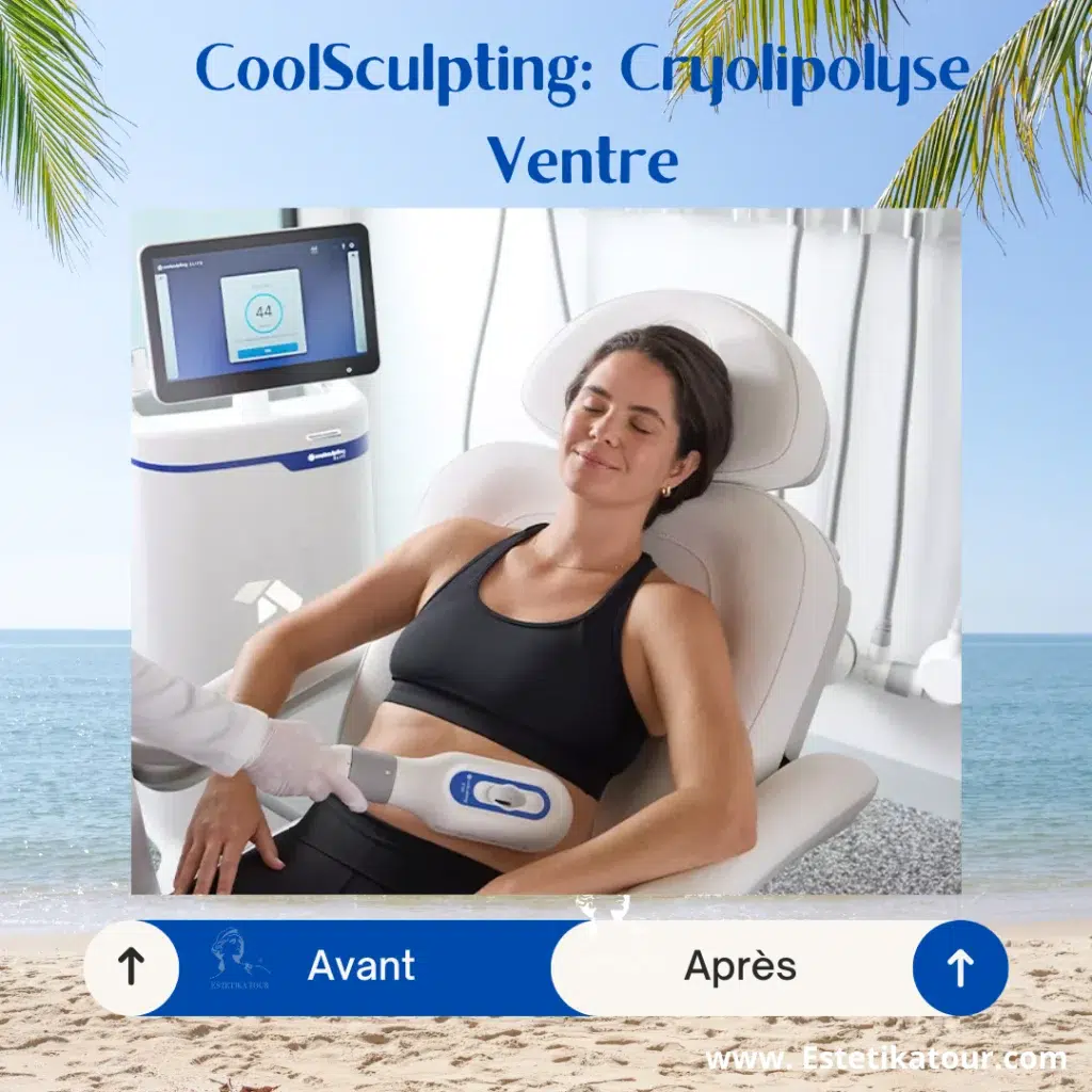 Cryolipolyse avant après coolsculpting