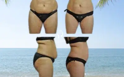 Cryolipolyse avant après CoolSculpting bien-être