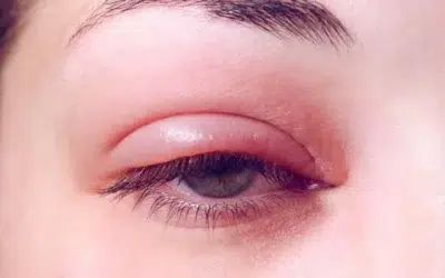 Allergie yeux gonflés