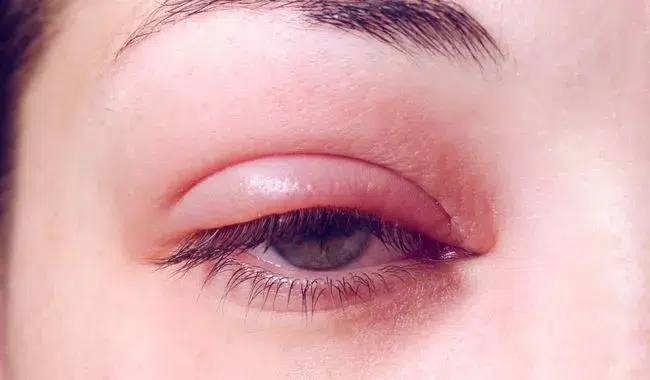 allergie yeux gonflés