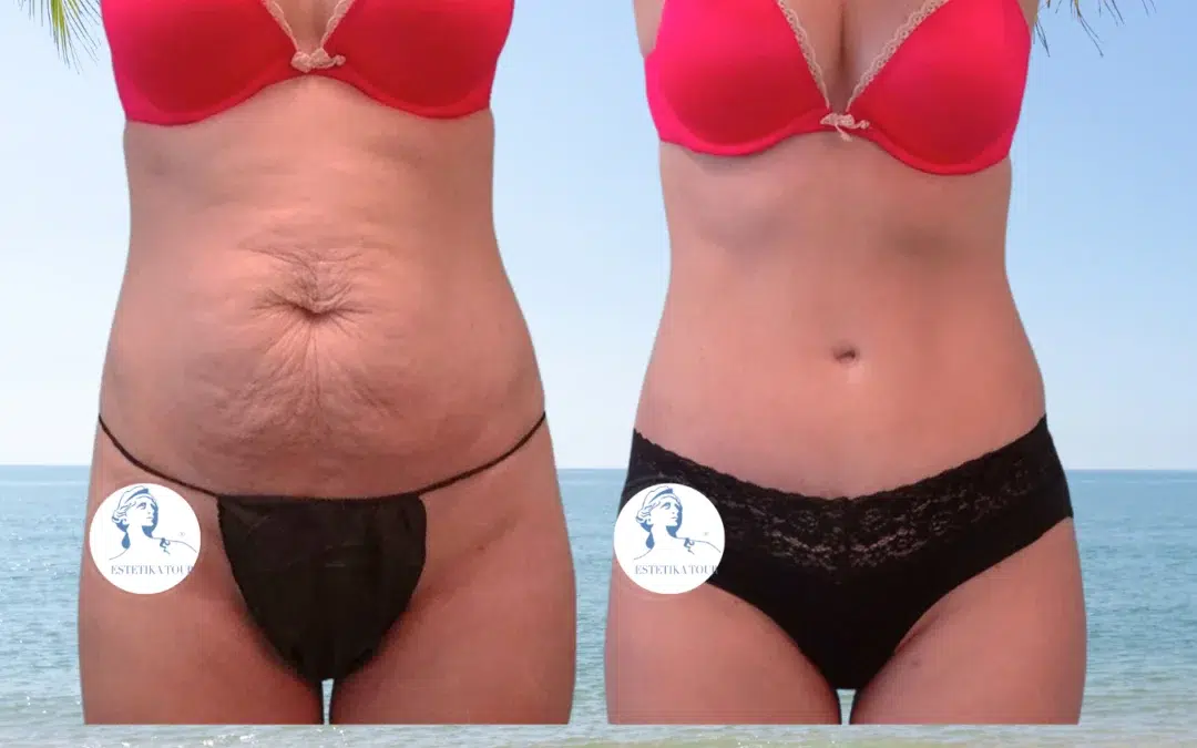 Abdominoplastie paris