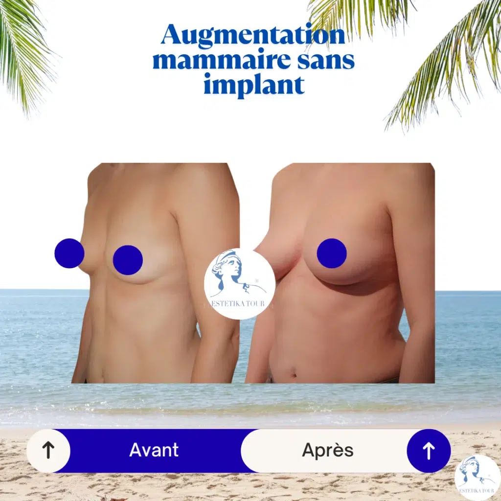 augmentation mammaire sans implant