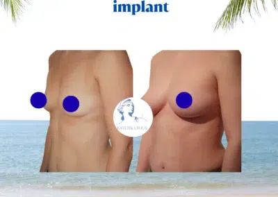 augmentation mammaire sans implant