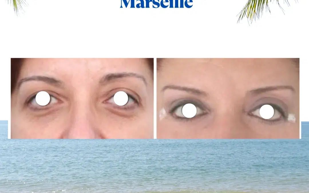 Blépharoplastie meilleur chirurgien marseille