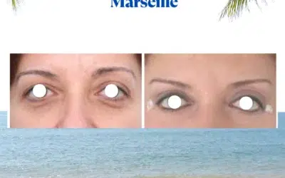 Blépharoplastie meilleur chirurgien marseille