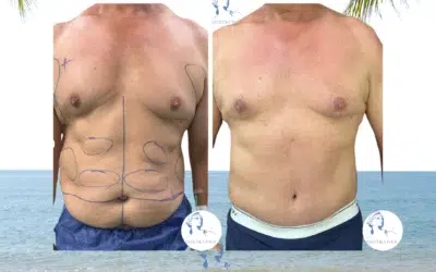 Abdominoplastie homme