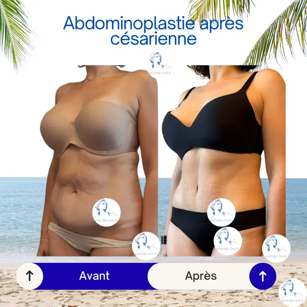 Abdominoplastie après césarienne