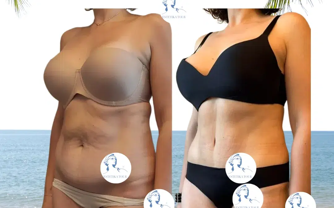 Abdominoplastie après césarienne