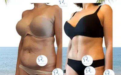 Abdominoplastie après césarienne