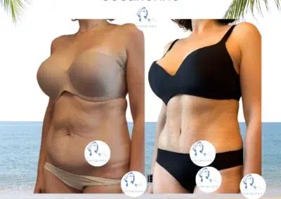 Abdominoplastie après césarienne