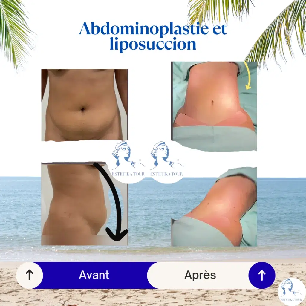 Abdominoplastie et liposuccion