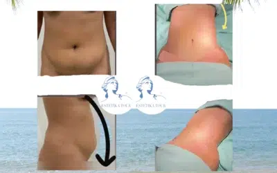 Abdominoplastie et liposuccion