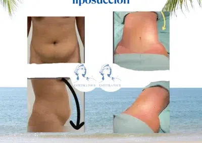 Abdominoplastie et liposuccion, Abdominoplastie ou liposuccion