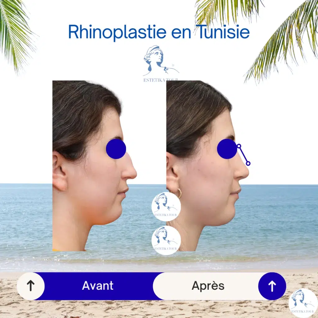 Rhinoplastie tunisie prix pas cher