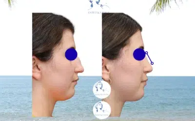 Rhinoplastie Tunisie Soins postoperatoires rhinoplastie instructions Tunisie