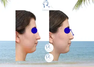 Rhinoplastie tunisie prix pas cher, Rhinoplastie prix tunisie, Soins postoperatoires rhinoplastie, chirurgie du nez