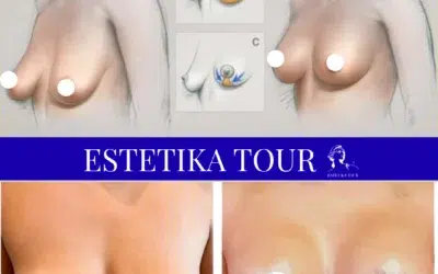 lifting des seins Lifting des seins avec prothèses
