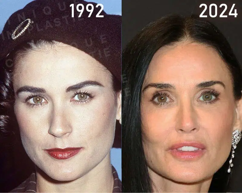demie moore chirurgie esthétique