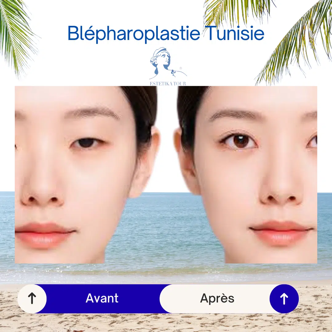 chirurgie des paupières asiatiques