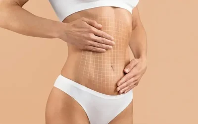 Tummy tuck Abdominoplastie et prise en charge : quelles sont les conditions en 2026 ?